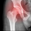 upload/articles/thumbs/230113114440hip fracture.jpg